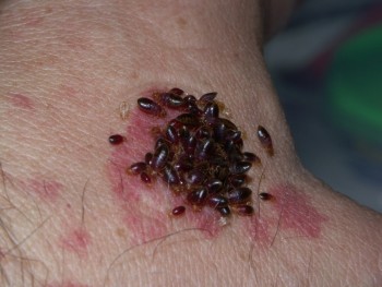 fleas bite treatment #11