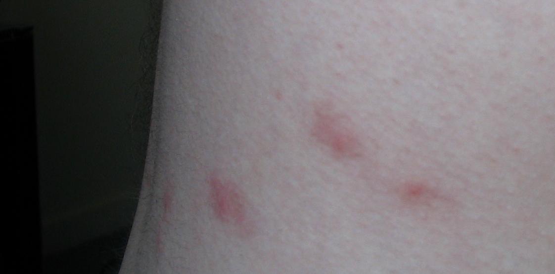Flea_bites.jpg