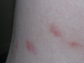 Flea_bites.jpg